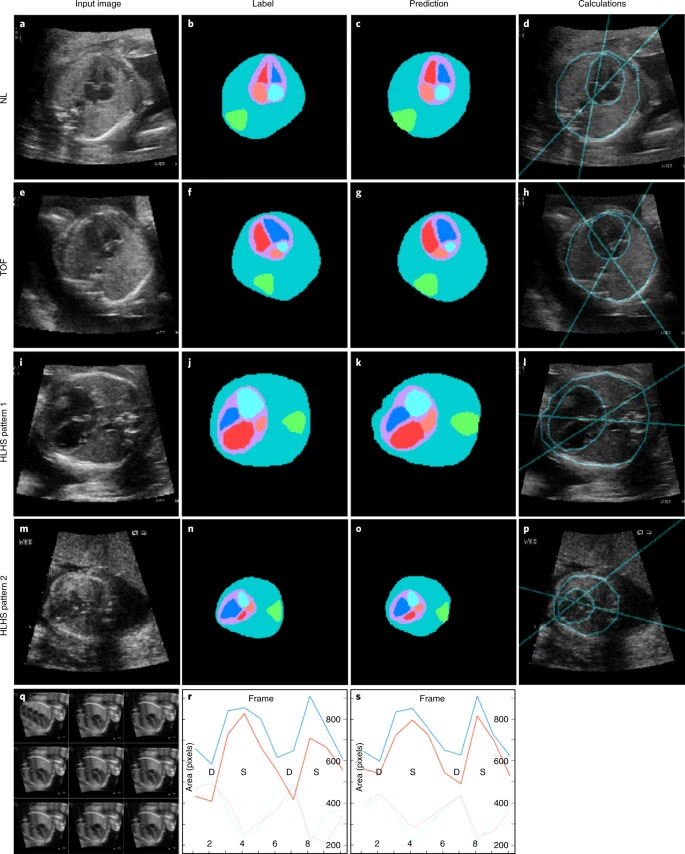 利用深度学习诊断心脏病集成模型的分割功能，分析胎儿心脏结构和功能测量。